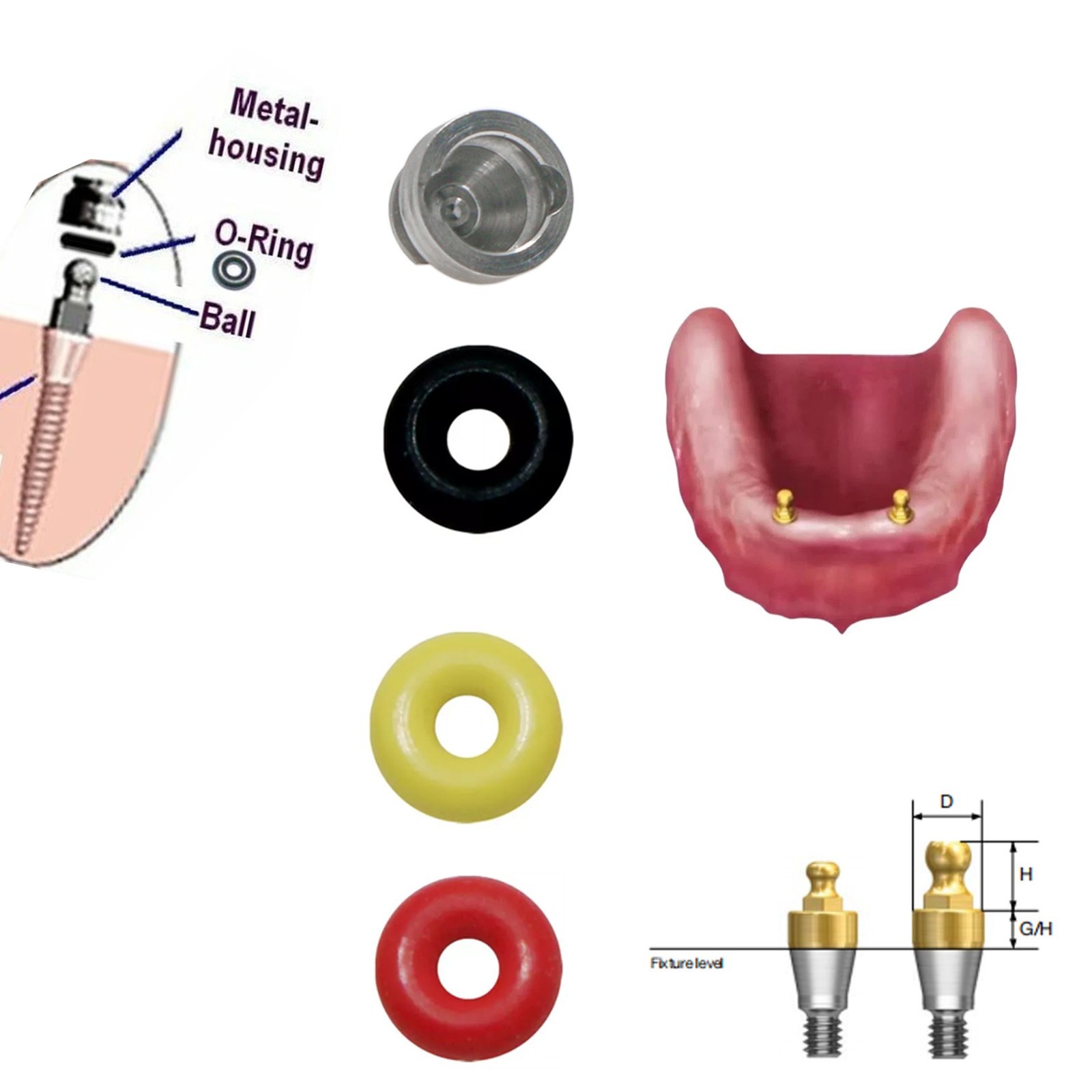 US Dental Hiossen/Osstem Fit Ball Abutment O-Ring Retention Kit Overdenture Caps