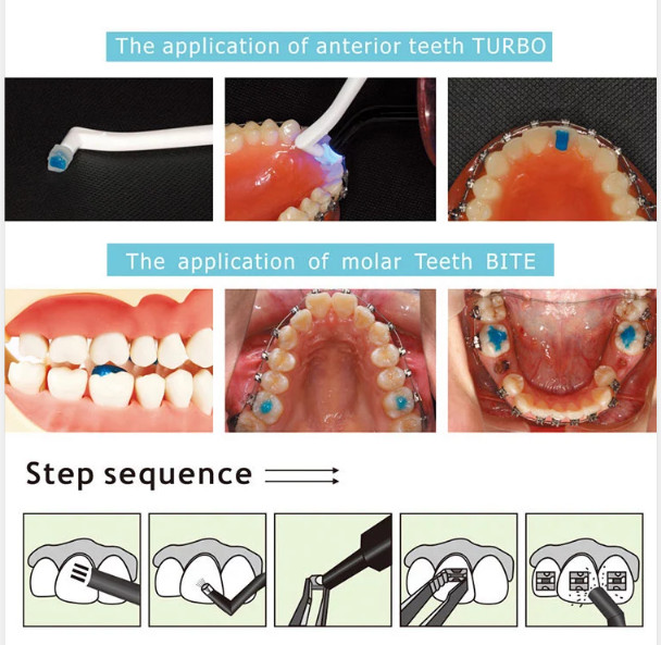 Dental TURBO Blue Glue Composite Resin Orthodontic Adhesive Light Cure Band 5ml