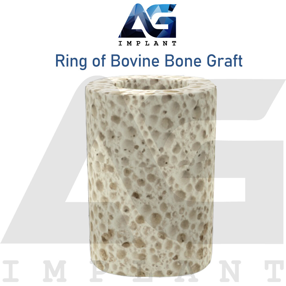 3D Ring Of Natural Graft Material Sterile Blister Immediate Load Sockets