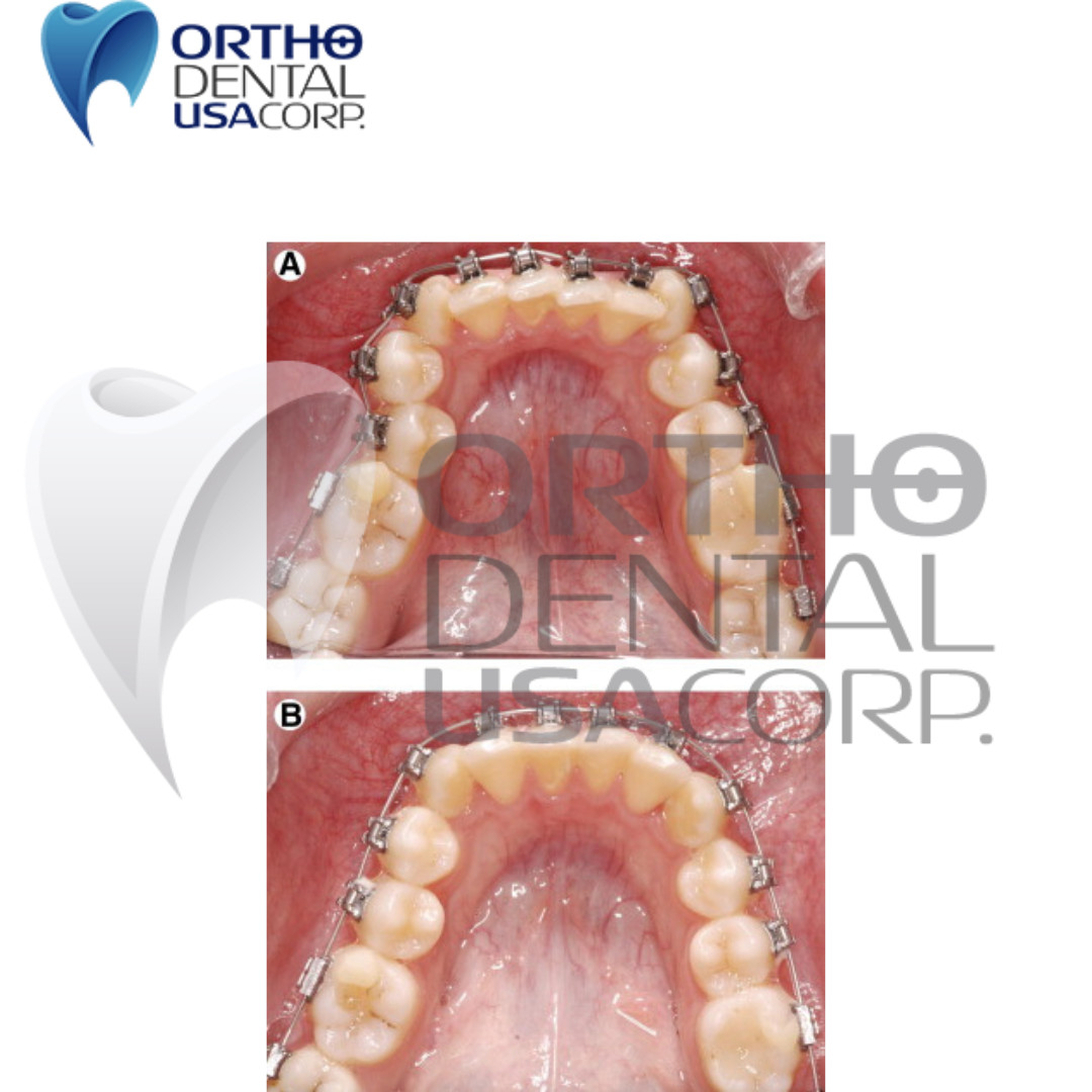 Thermal Niti Archwire Natural Upper 016×016 pack x 10 Orthodentalusa USA seller