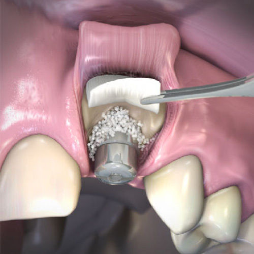Syntoss Dental Implant Collagen Resorbable Surgical Membrane Barrier 25x25mm