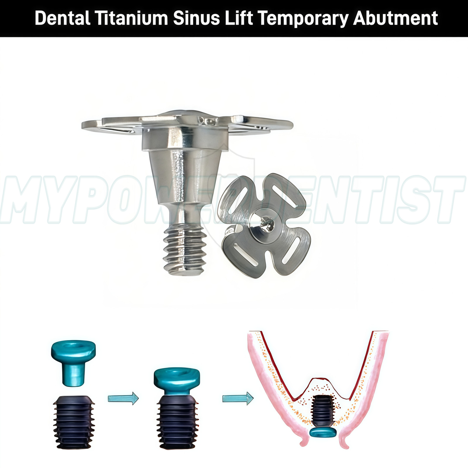 Dental Titanium Lift Temporary Implant Abutment Repair Accessories Fit Oss