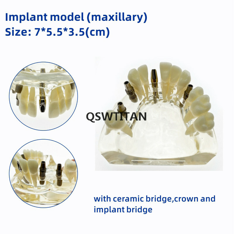 Dental implant model Dental teaching model Teeth model with bridge and caries