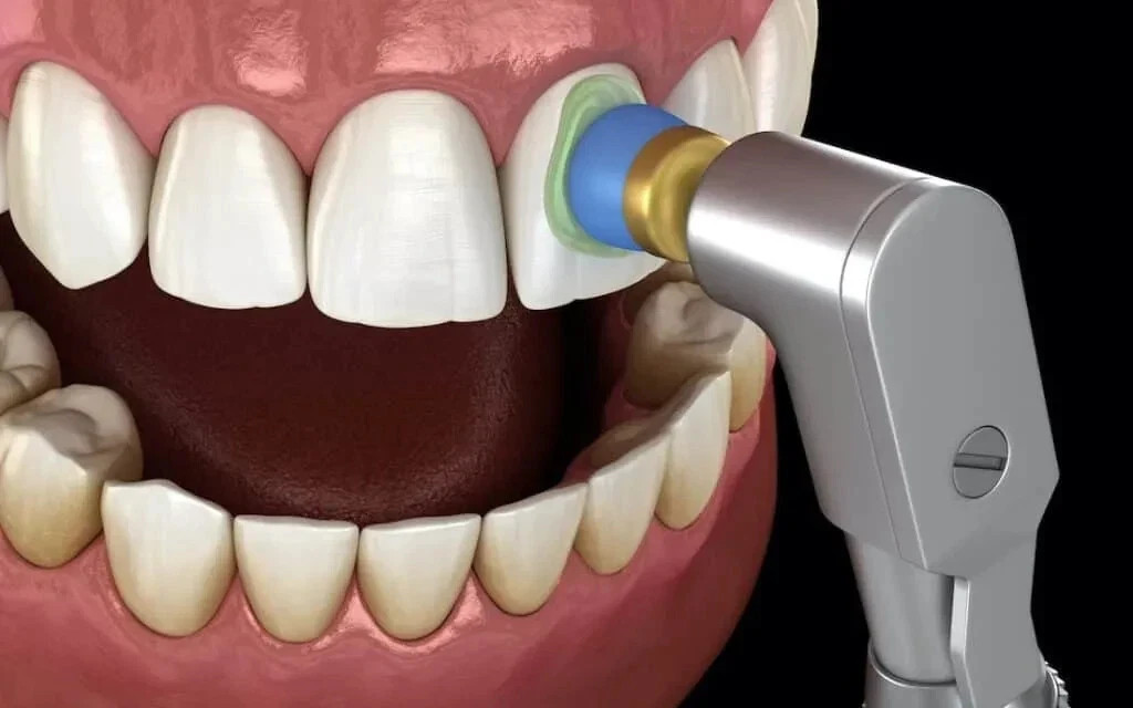 Dental SPECTRA Prophylaxis Polishing Paste After Scaling 75g Jar MINT FLAVOUR
