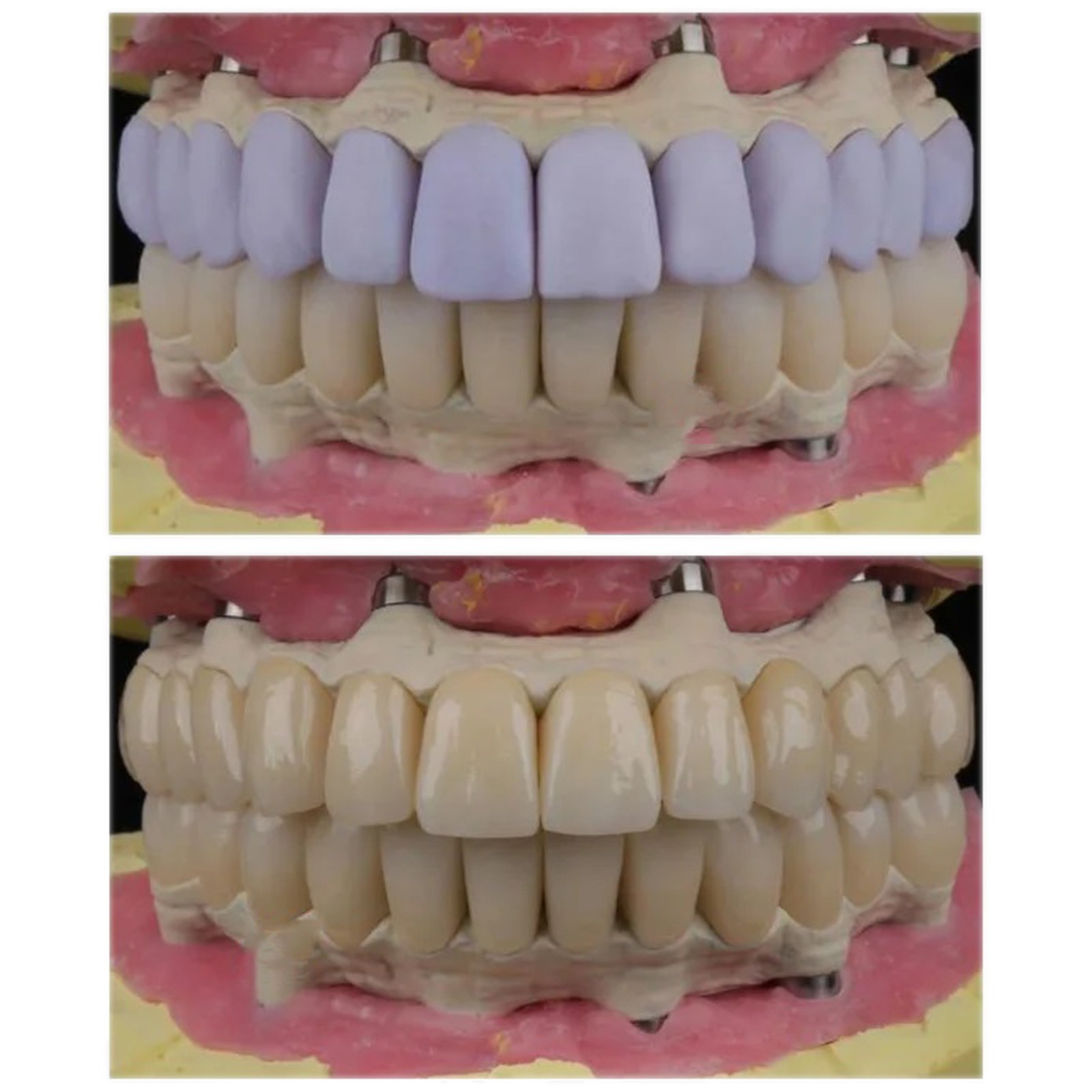 US HT C14 Emax Dental Glass Ceramic Lithium Dislicate CAD/CAM Cerec Blocks