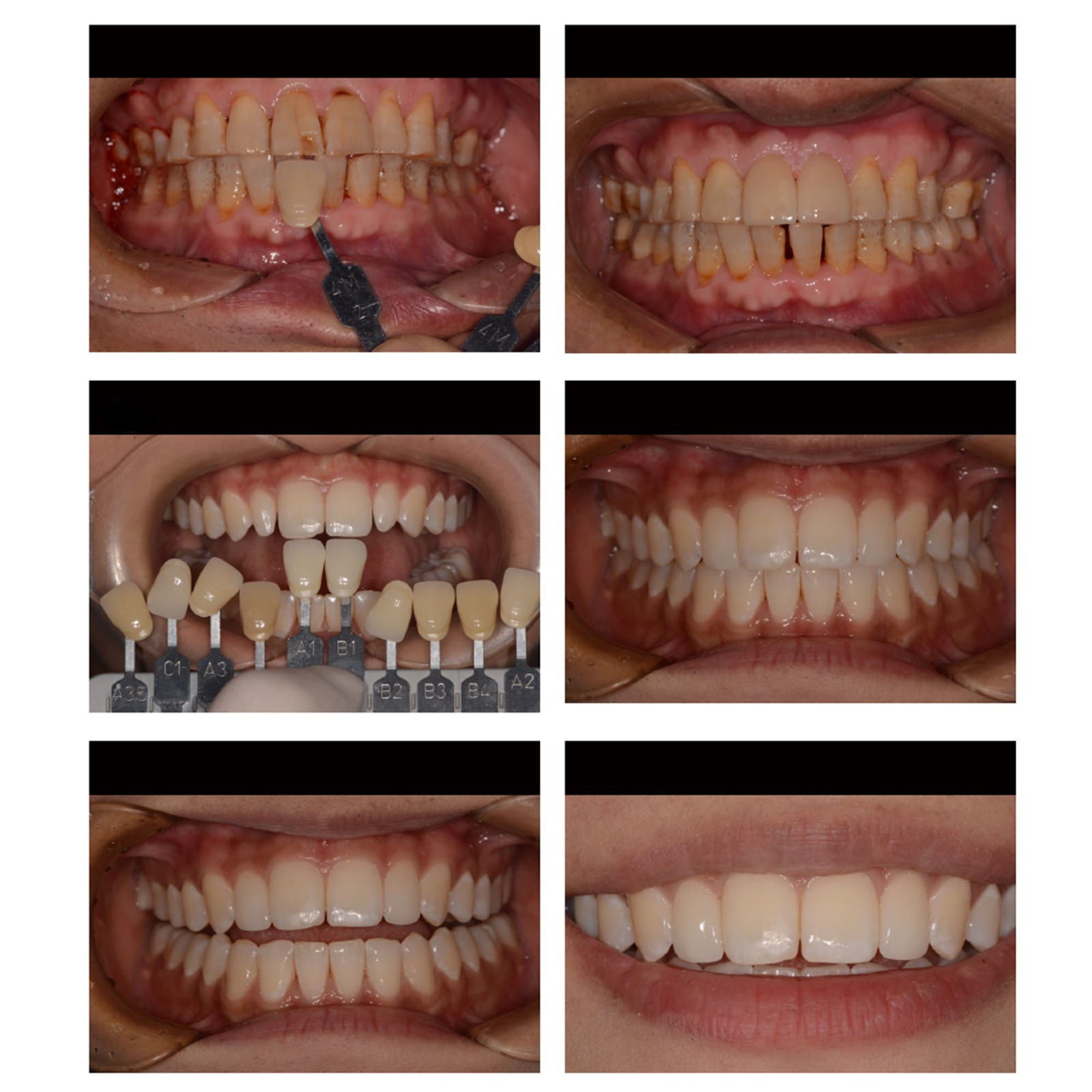 US C14 LT Dental Emax Glass Ceramic Lithium Disilicate Block CAD/CAM CEREC Inlab