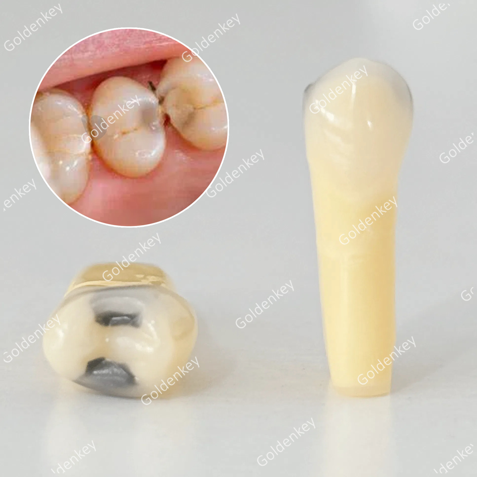 Dental Teeth Model Cavities 25 Fit Frasaco AG-3 Undermining Caries Train Replace