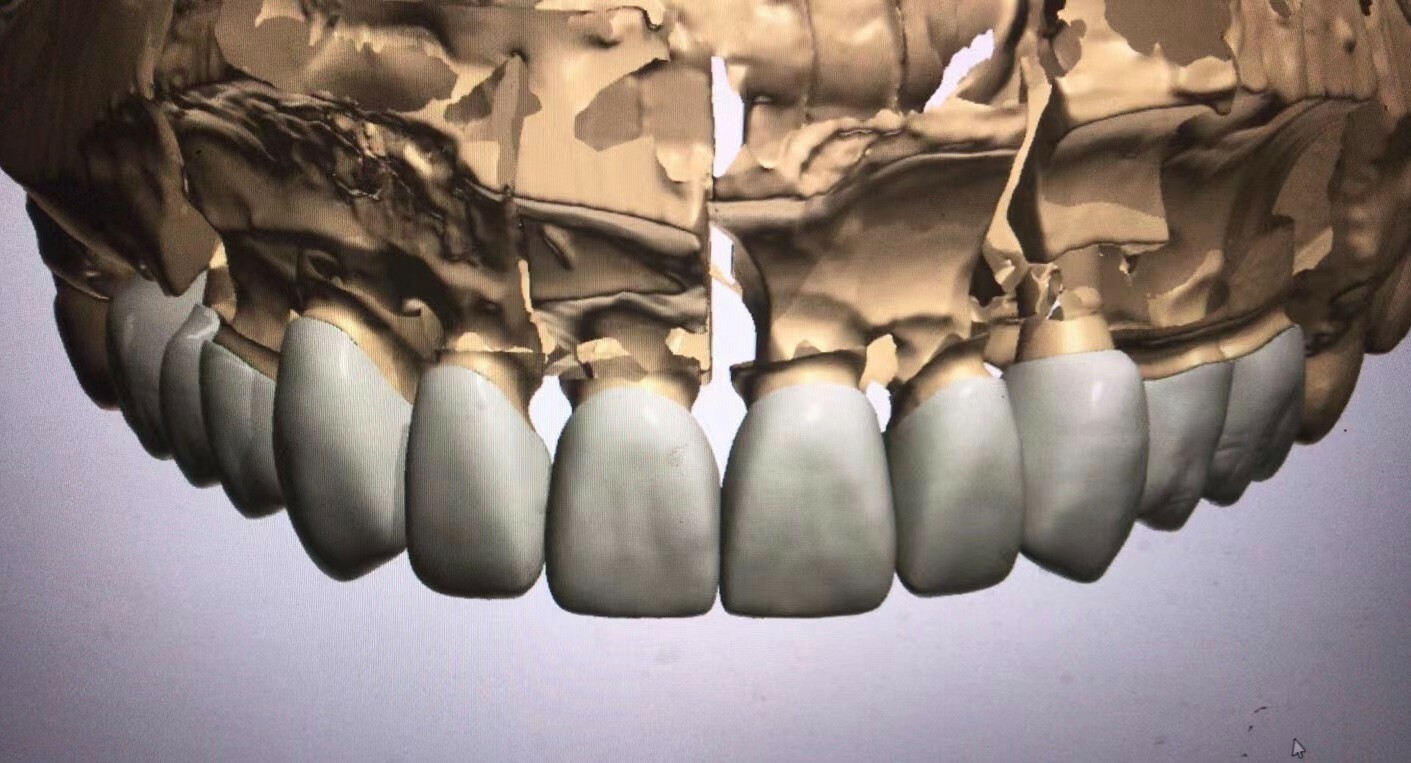 Crown & Bridge & Implant abutment Design Service & Digital CAD/CAM 