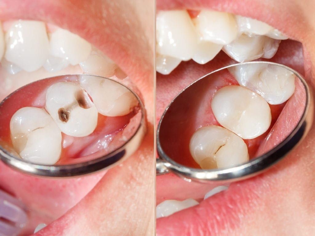 DentGist NanoCom Restorative Composite Refills 4g