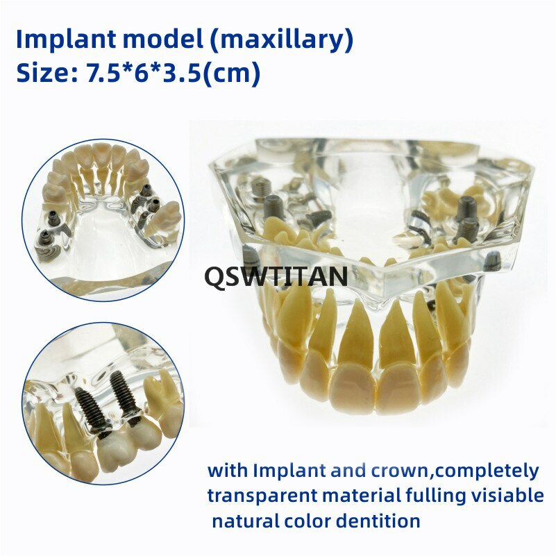 Dental implant model Dental teaching model Teeth model with bridge and caries