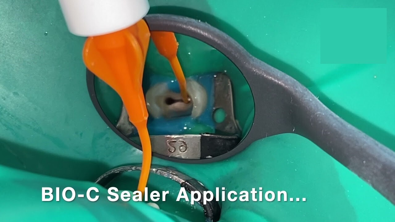 Angelus Bio C Sealer Ready To Use Bioceramic Root Canal Sealer (Free Ship)