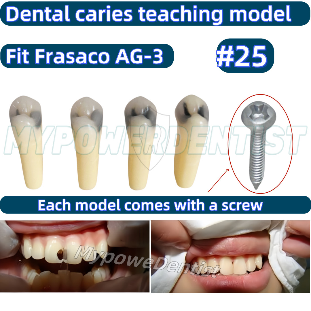 Dental Cavity Teeth Model Tooth Teaching Caries 25# Compatible Frasaco AG-3