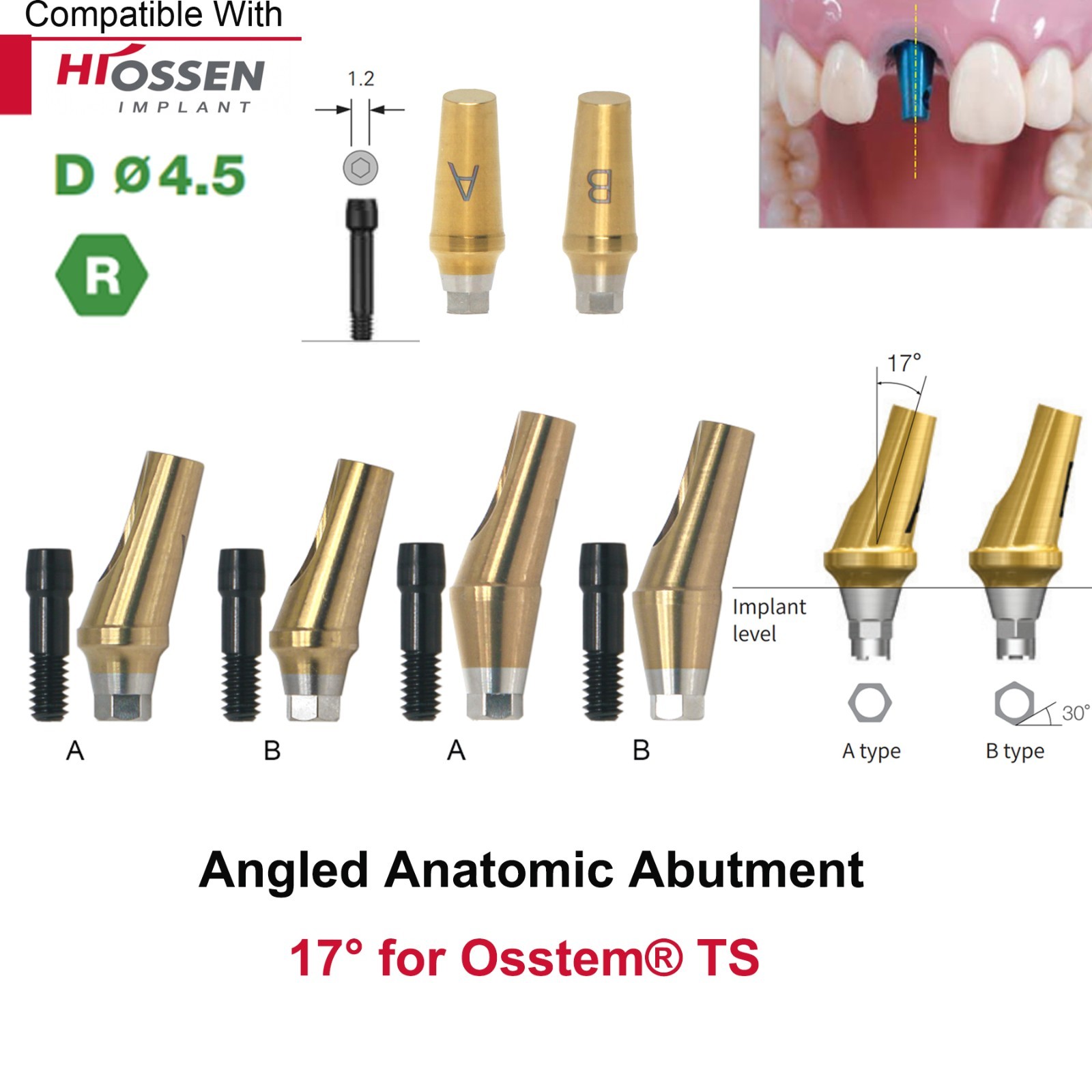 US 17° Angulated Abutment Mini/Regular Hex A/B Transfer Fit Osstem TS/Hiossen ET