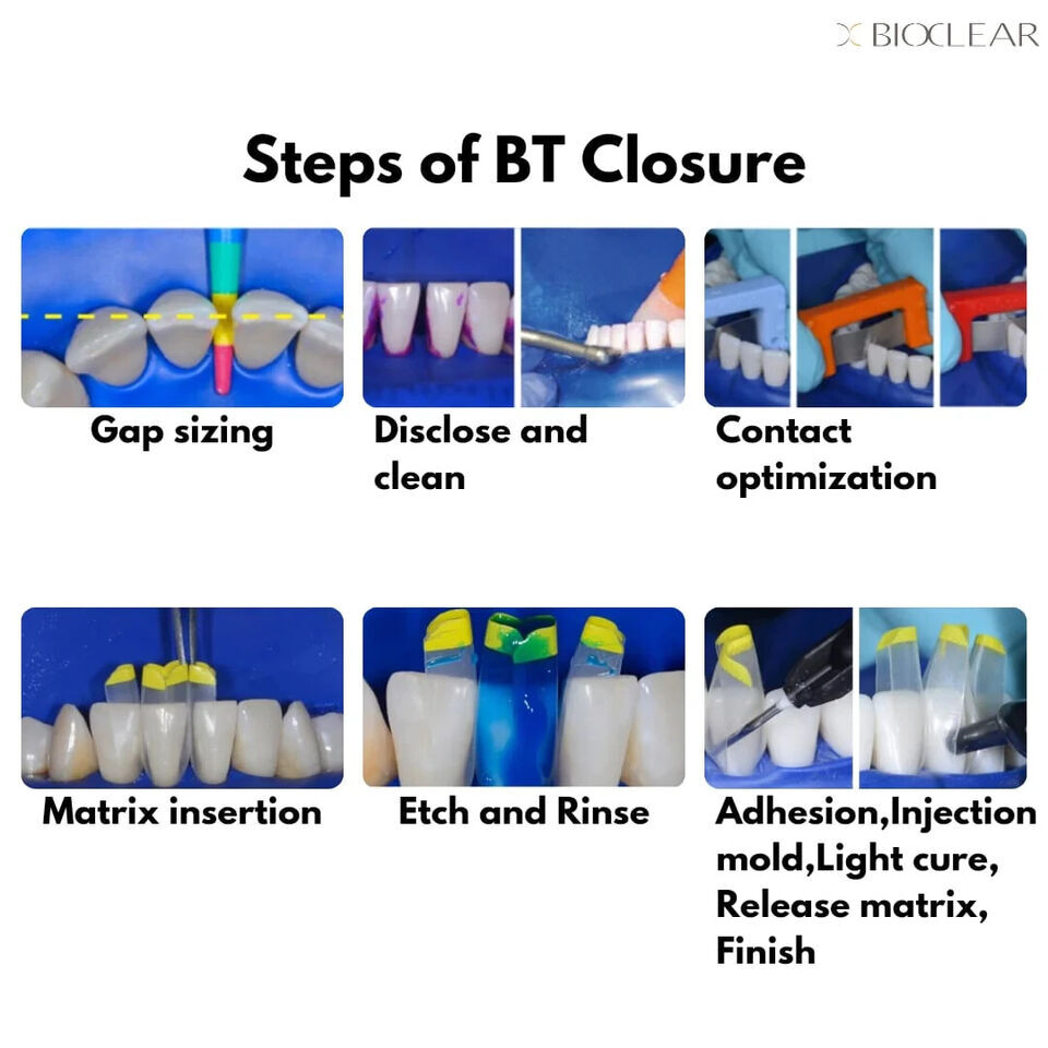 Dental Clear Matrix Anterior/Posterior Teeth Transparent Matrix Fit Bioclear BT