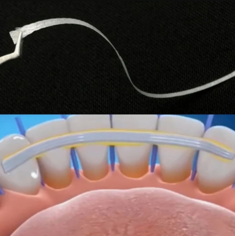 Dental Flexible Fiber Strip Glass Splint Loose Tooth Fixat Strip Light Cure Bond