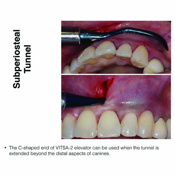 Implant Dent-VISTA:Vestibular Incision Subperiosteal Tunneling Access Kit