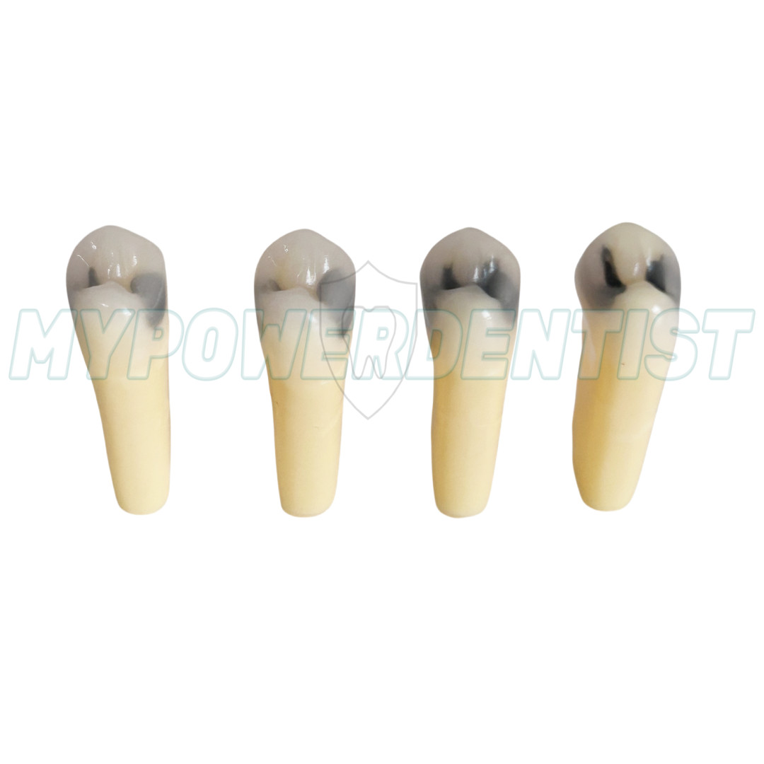 Dental Cavity Teeth Model Tooth Teaching Caries 25# Compatible Frasaco AG-3