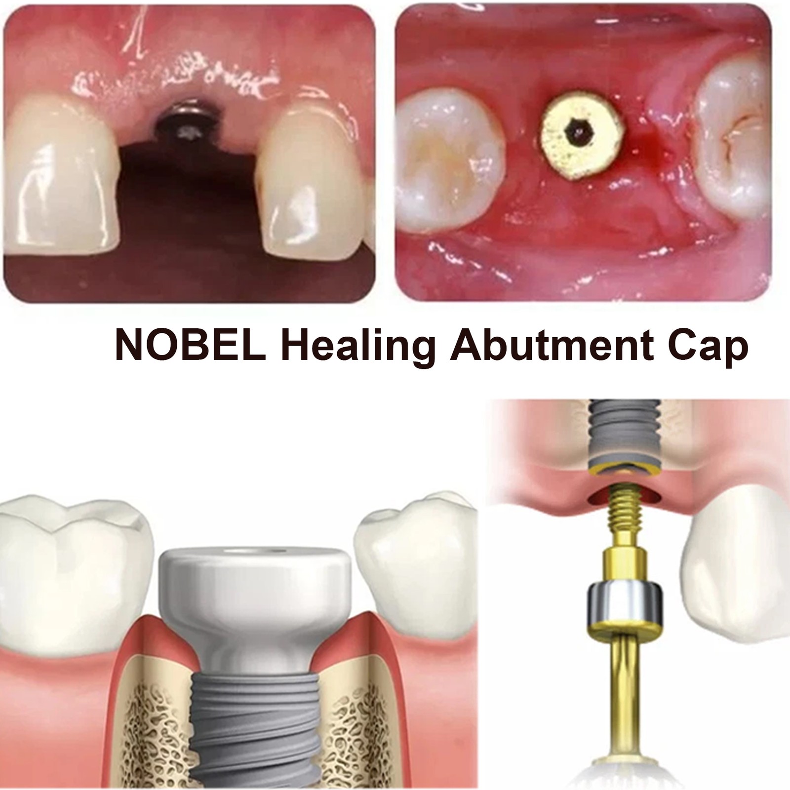 US Nobel Biocare Implant Healing Abutment Cap Titanium NP RP CC Temporary Dental