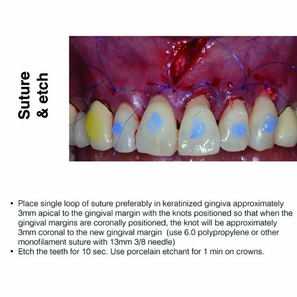 Implant Dent-VISTA:Vestibular Incision Subperiosteal Tunneling Access Kit