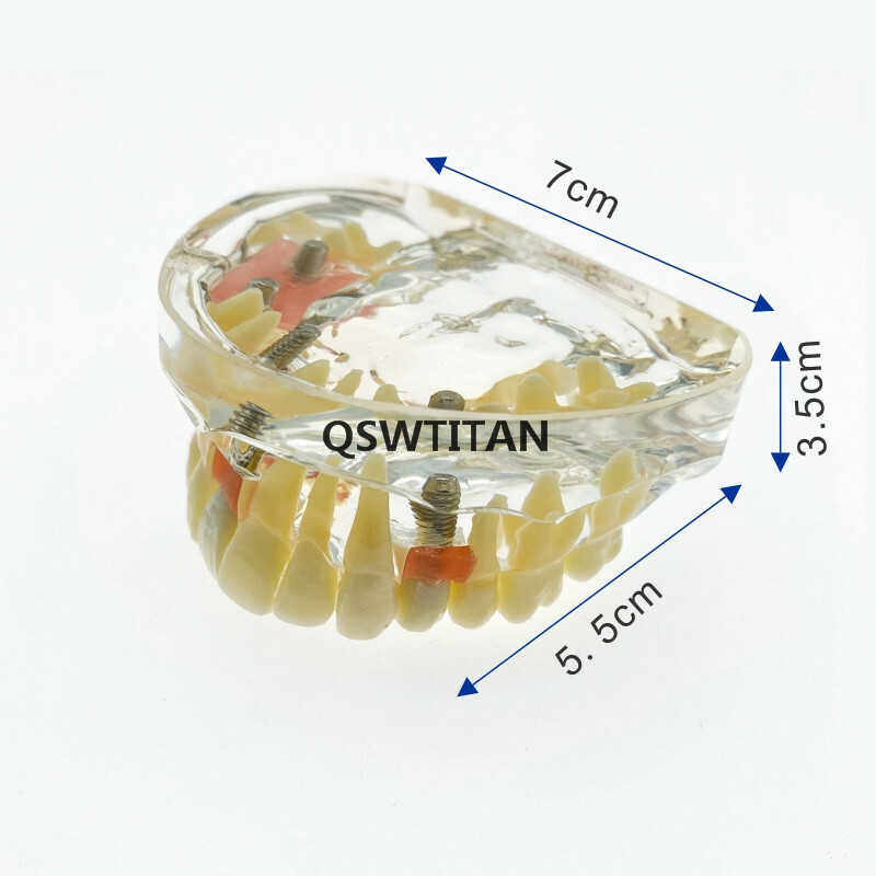 Dental implant model Dental teaching model Teeth model with bridge and caries
