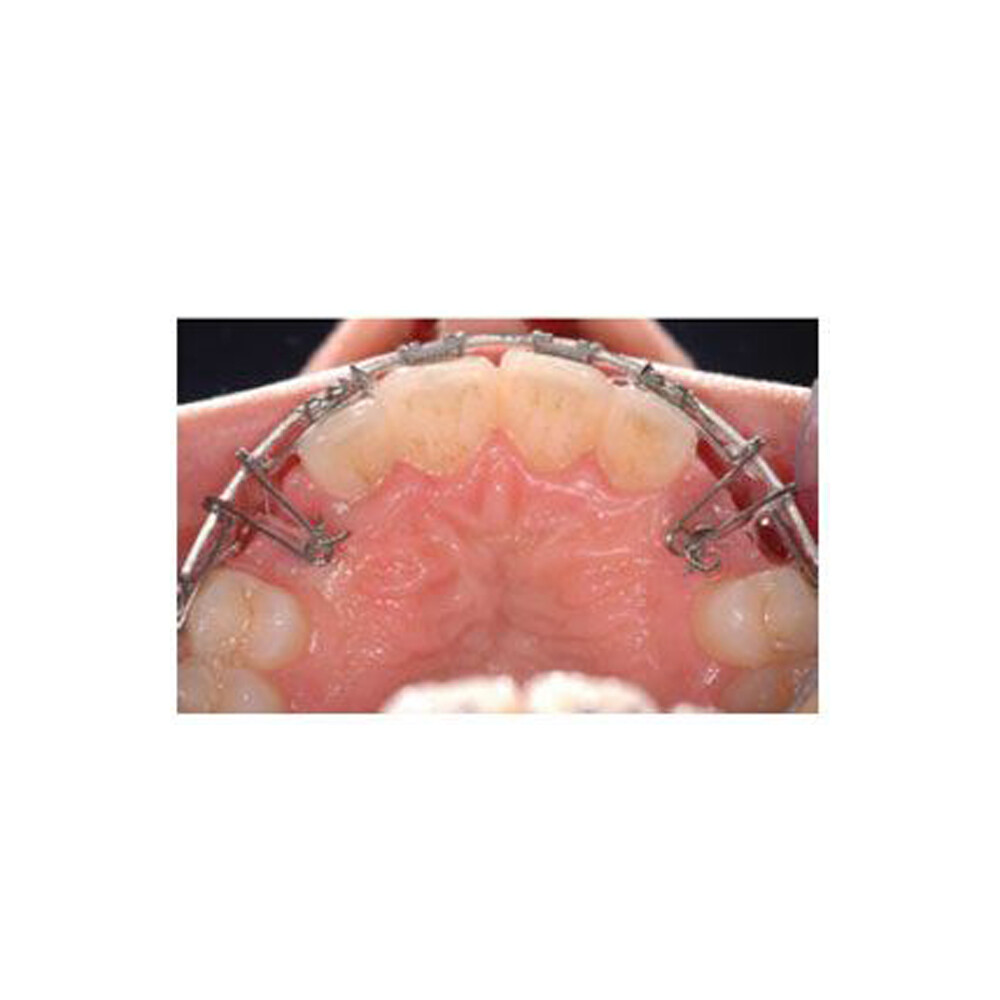J&J Ortho Orthodontic Double Torsion Spring (Kilroy Spring Equivalent) 10/pk