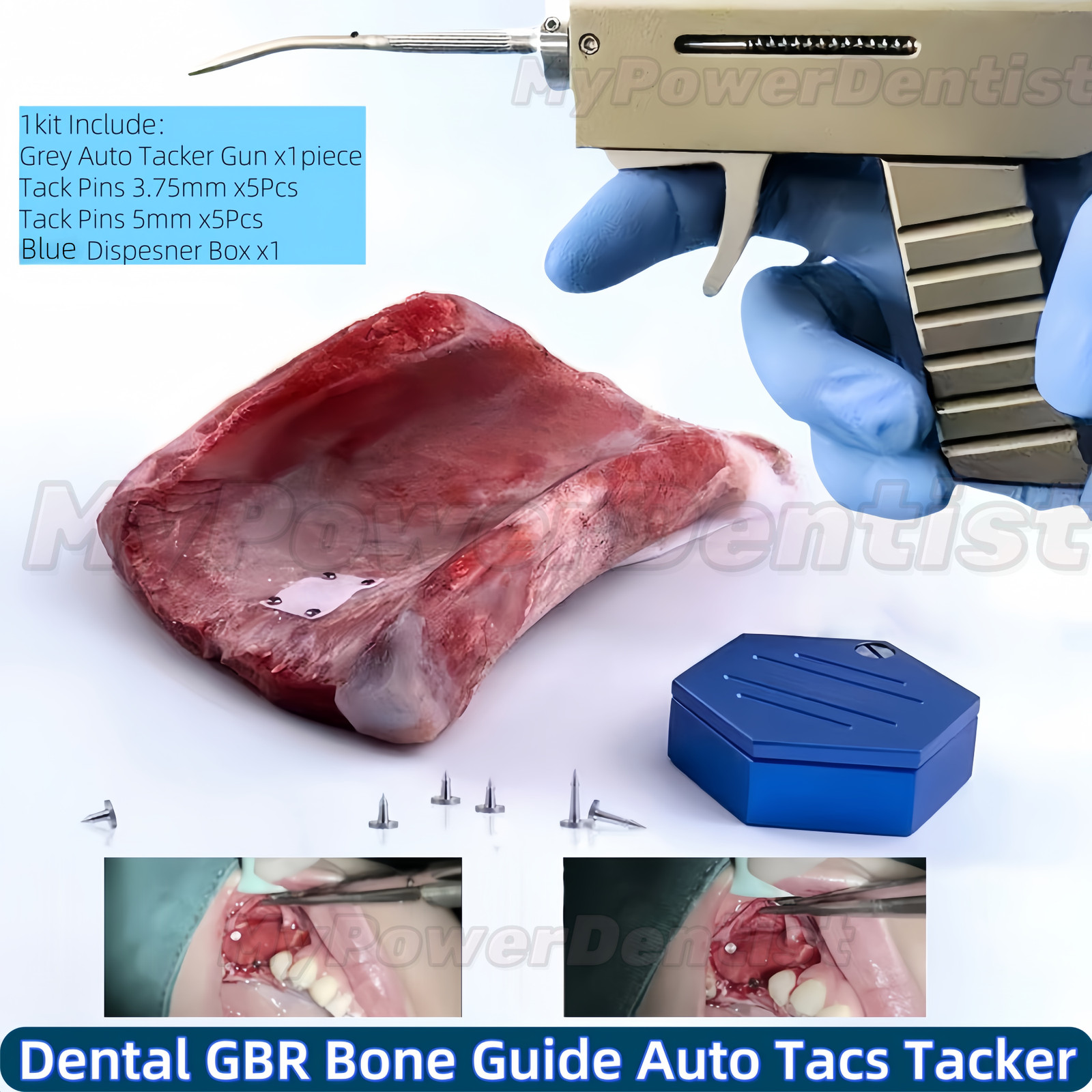 12Pcs Dental GBR Bone TAC Titanium Pins Gun Membrane Guide Auto Tacs Tacke kit