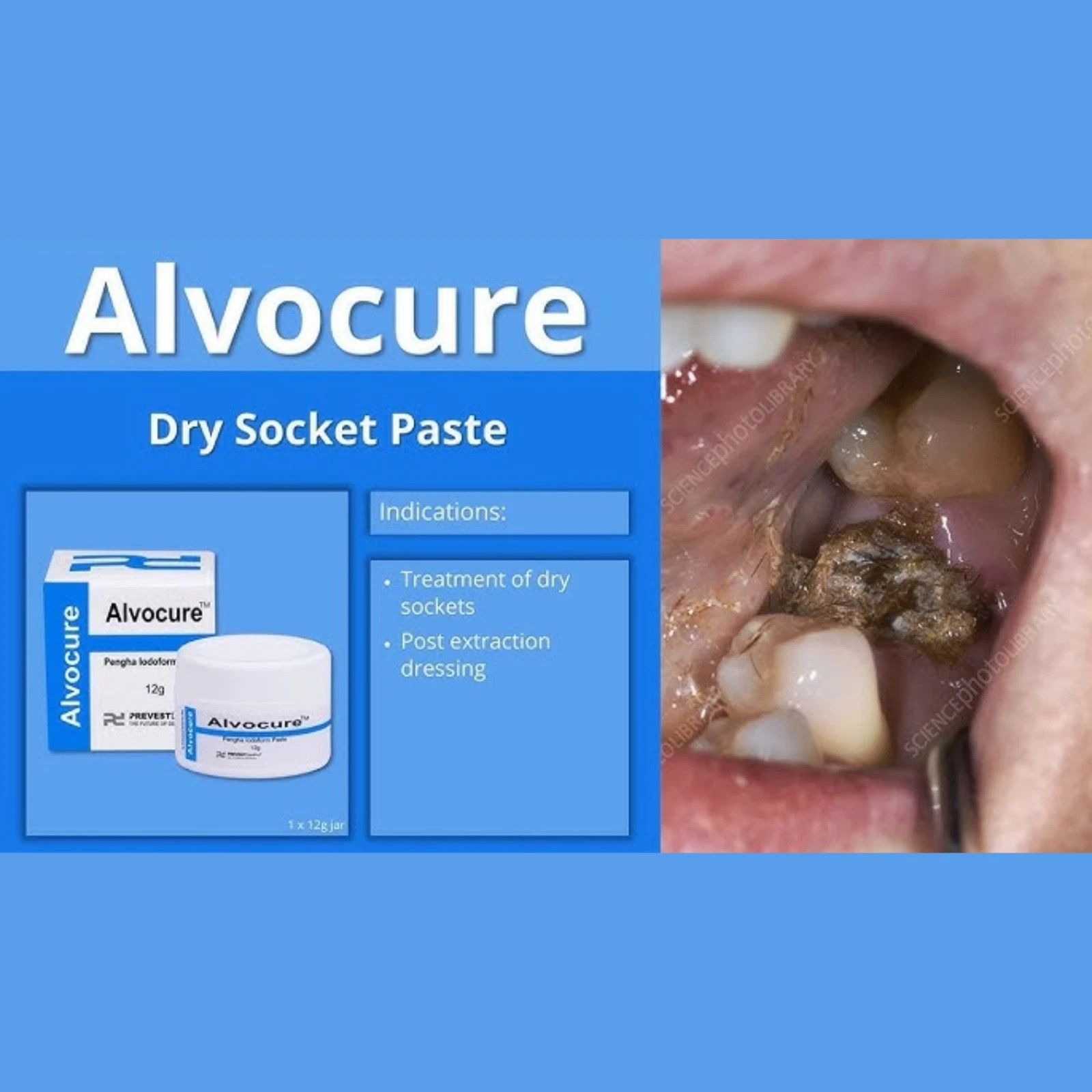 Alvocure Iodoform Paste Eugenol Dental Alveolar Dressing Analgesic Styptic 12g