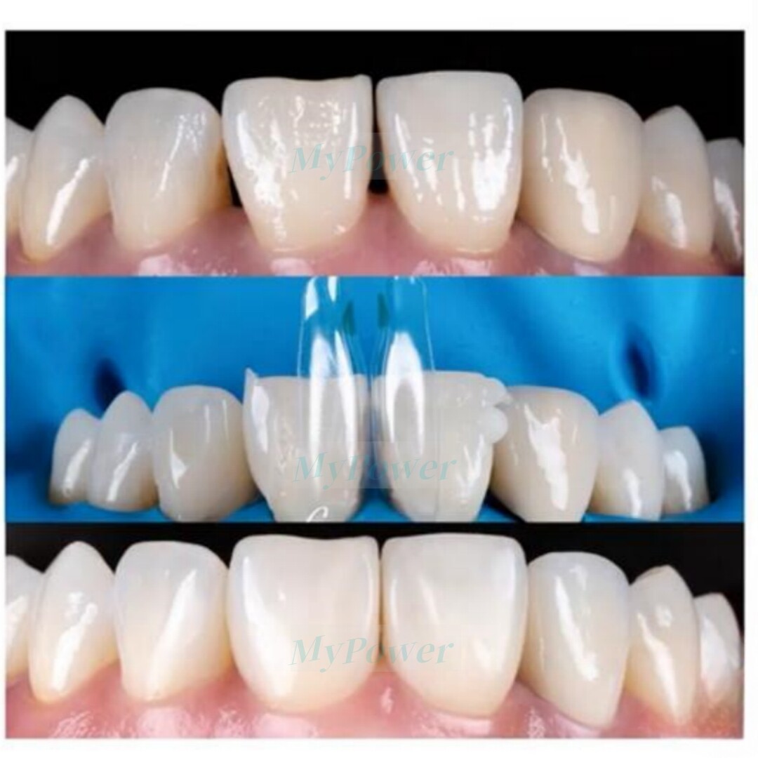 Dental Clear Matrix Anterior/Posterior Teeth Transparent Matrix Fit Bioclear BT