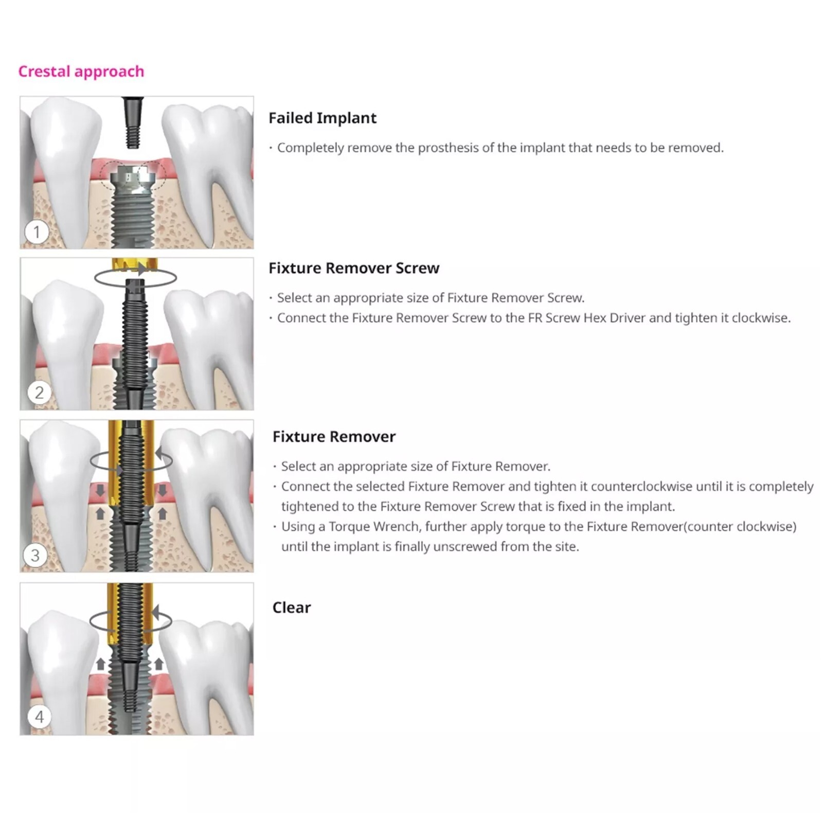 US Dental Implant Fixture Screw Remover Kits Neobiotech SR FR Repair Rescue Set