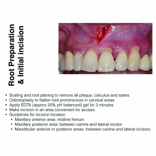 Implant Dent-VISTA:Vestibular Incision Subperiosteal Tunneling Access Kit