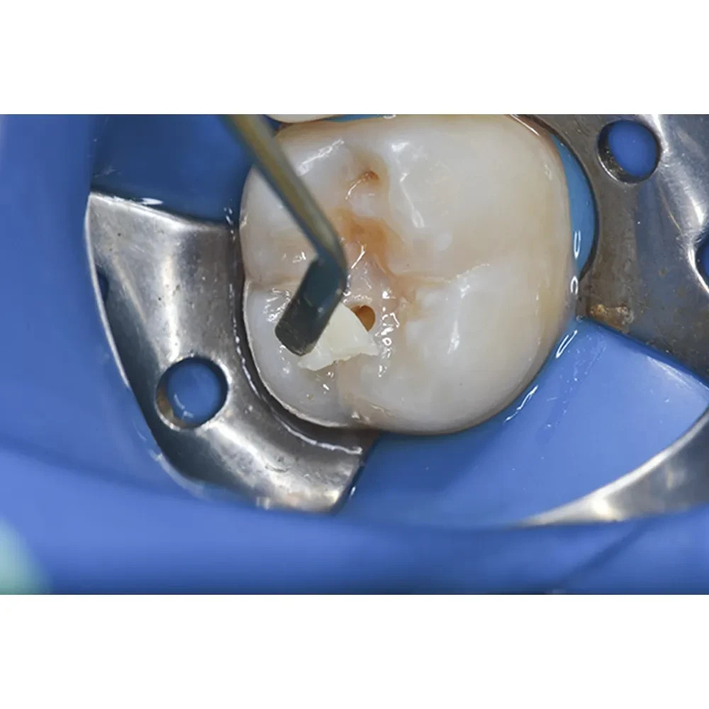 Prime Dental Restorite Micro Hybrid Kit Restorite micro-hybrid composite kit
