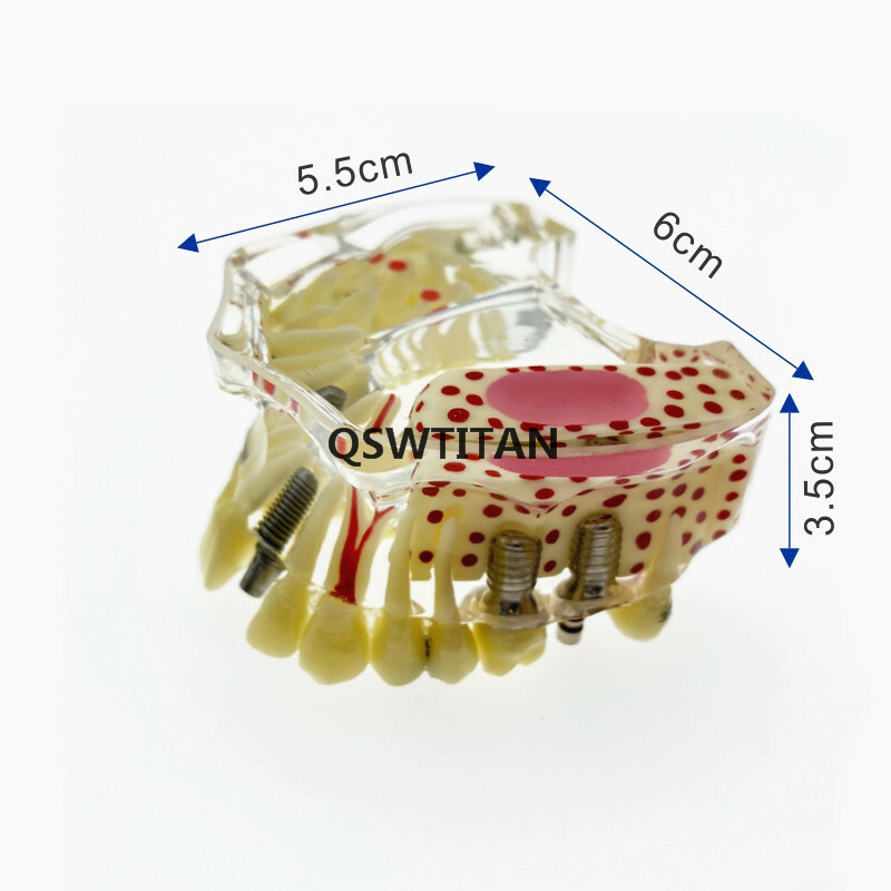 Dental implant model Dental teaching model Teeth model with bridge and caries