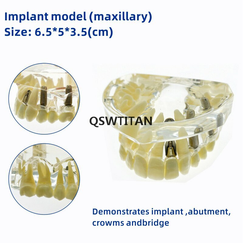 Dental implant model Dental teaching model Teeth model with bridge and caries
