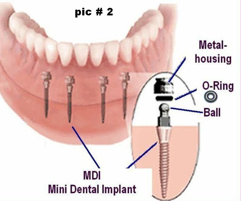 10 + 2* rubber O-RINGS size 4 – for Mini Dental Implant INTRA LOCK LARGE ONLY