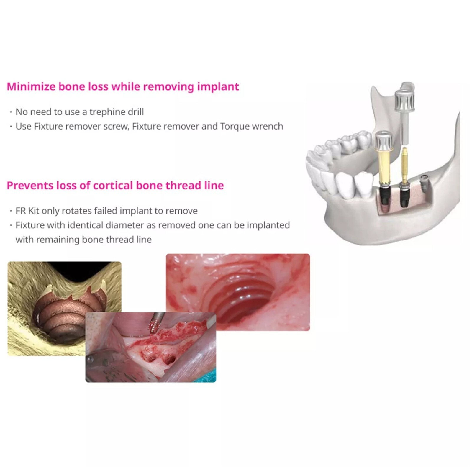 US Dental Implant Fixture Screw Remover Kits Neobiotech SR FR Repair Rescue Set