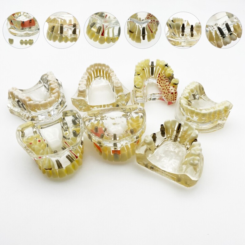 Dental implant model Dental teaching model Teeth model with bridge and caries