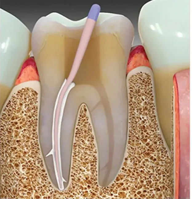 Ammdent Resinoseal Resin based root canal sealer