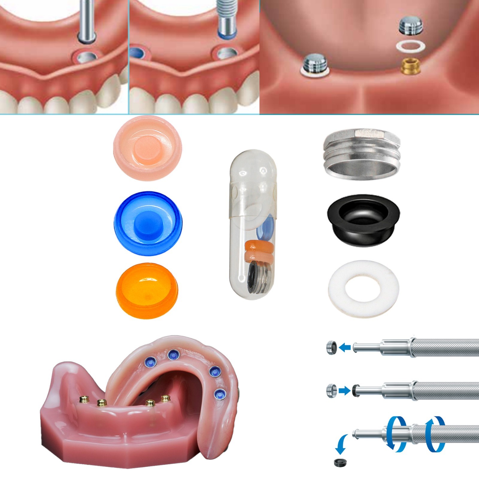 Locator Core Tool & Overdenture Retention Replacement Caps Insert 0.8/1.2/2.4lbs