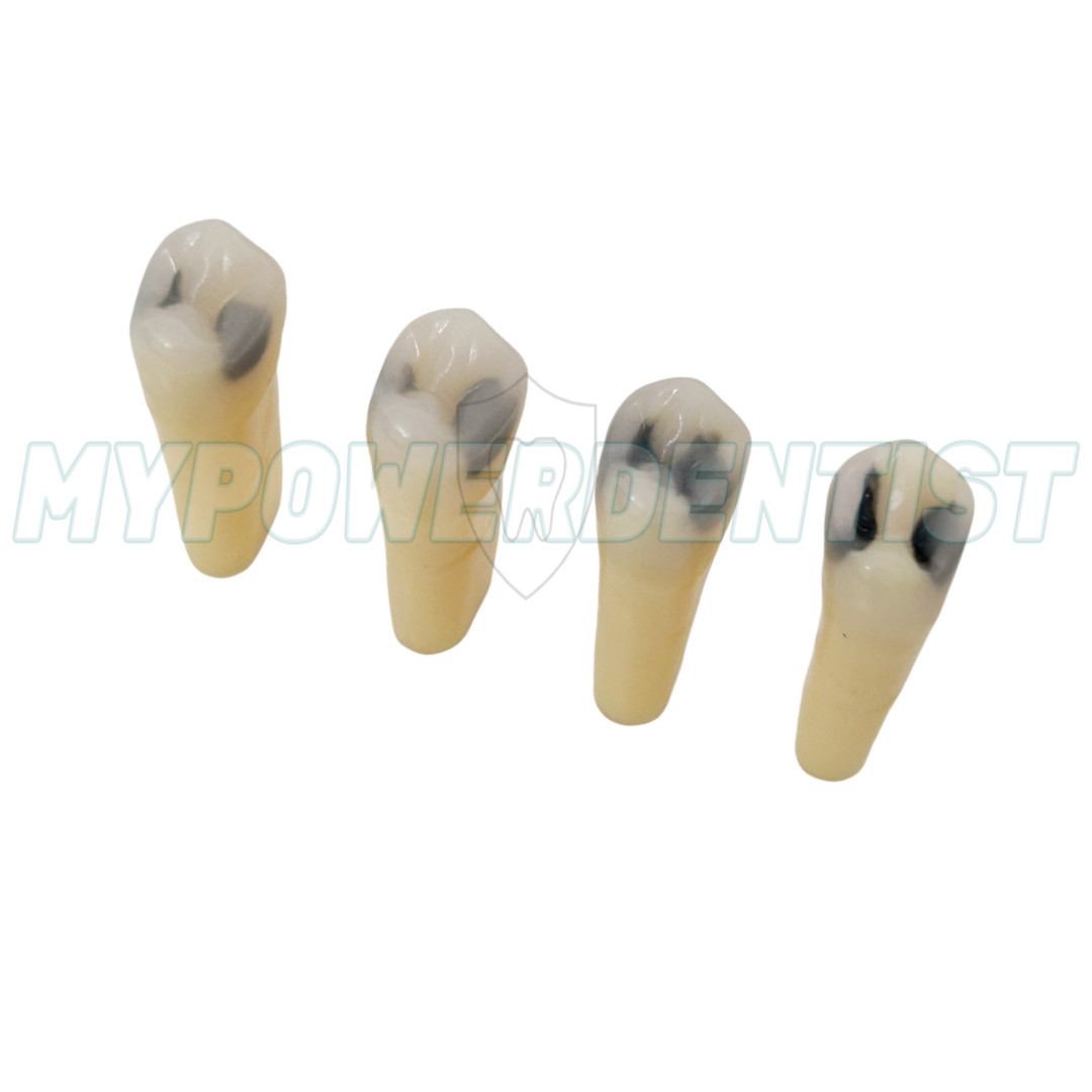 25# Dental Cavity Teeth Model Tooth Teaching Caries ModelCompatible Frasaco AG-3