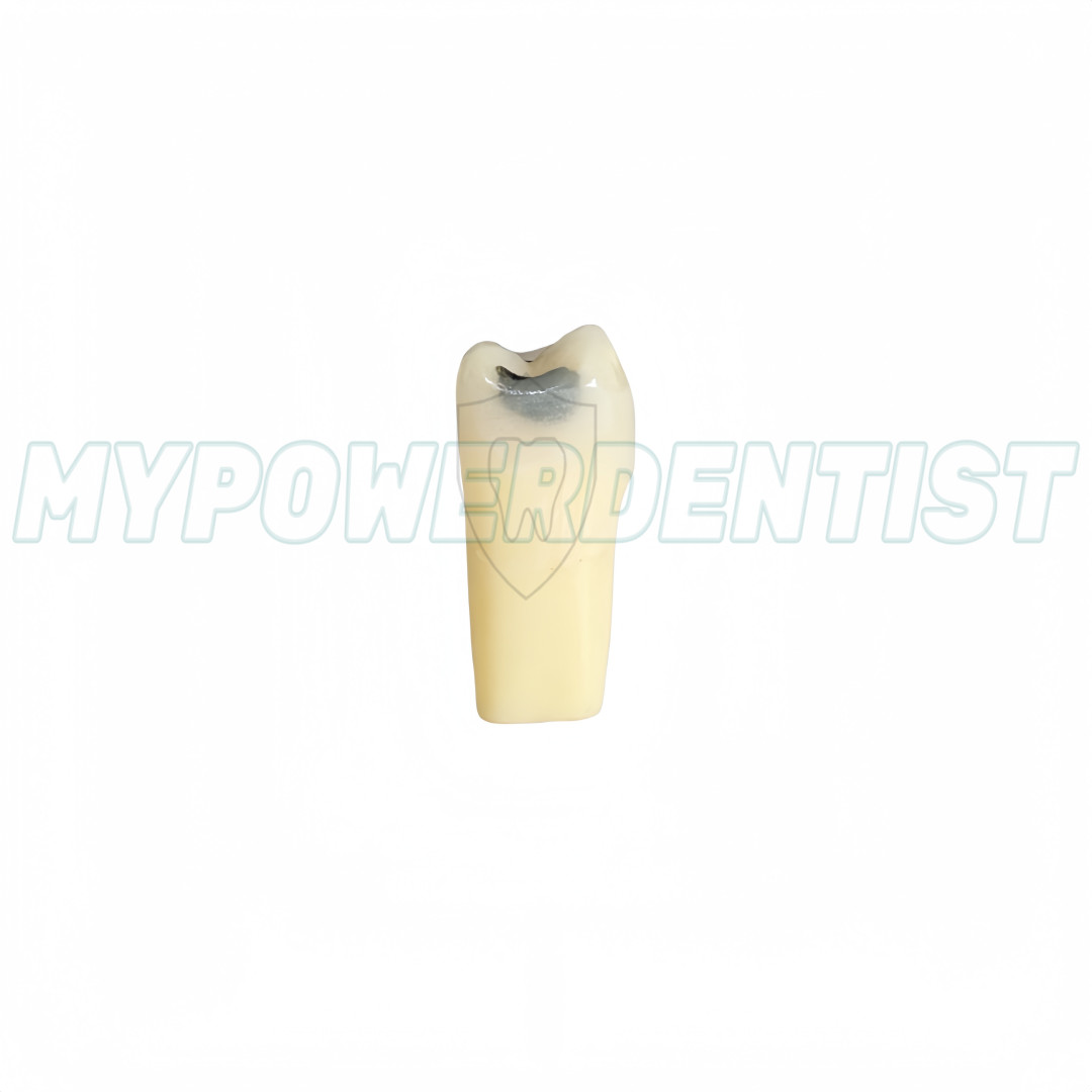 25# Dental Cavity Teeth Model Tooth Teaching Caries ModelCompatible Frasaco AG-3