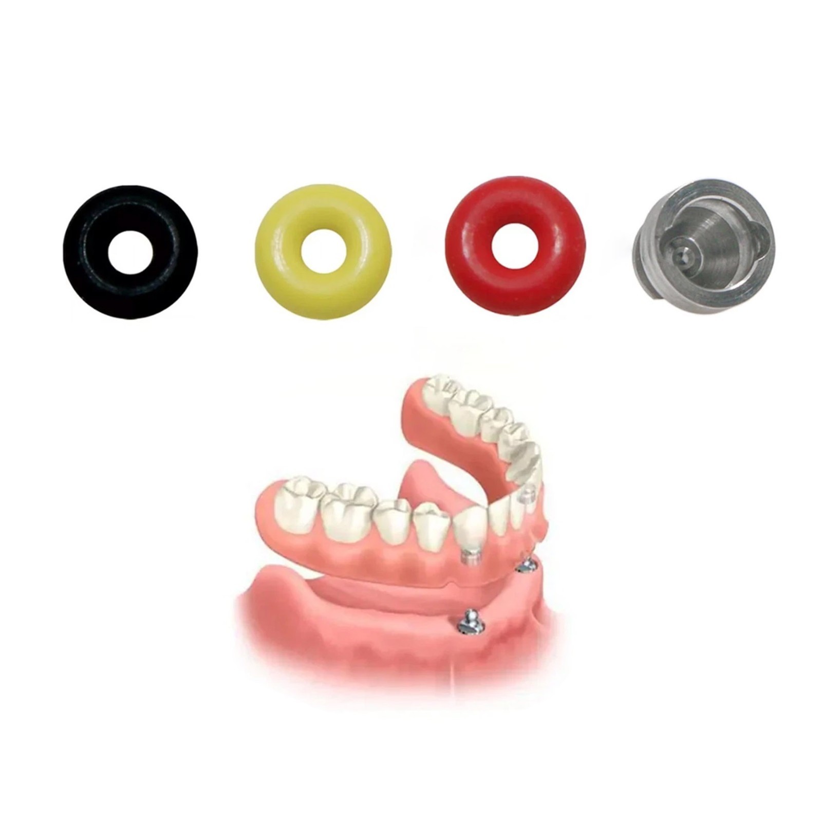 US Dental Ball Abutment O-Ring Caps Kit for Hiossen Osstem Overdenture 4Pcs/Set