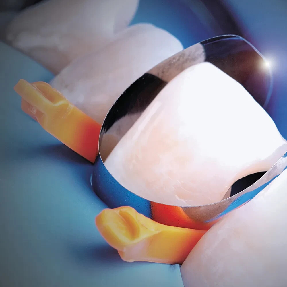 Voco Structur 3 QM Self Cure Composite Material for Crowns & Bridges (Free Ship)
