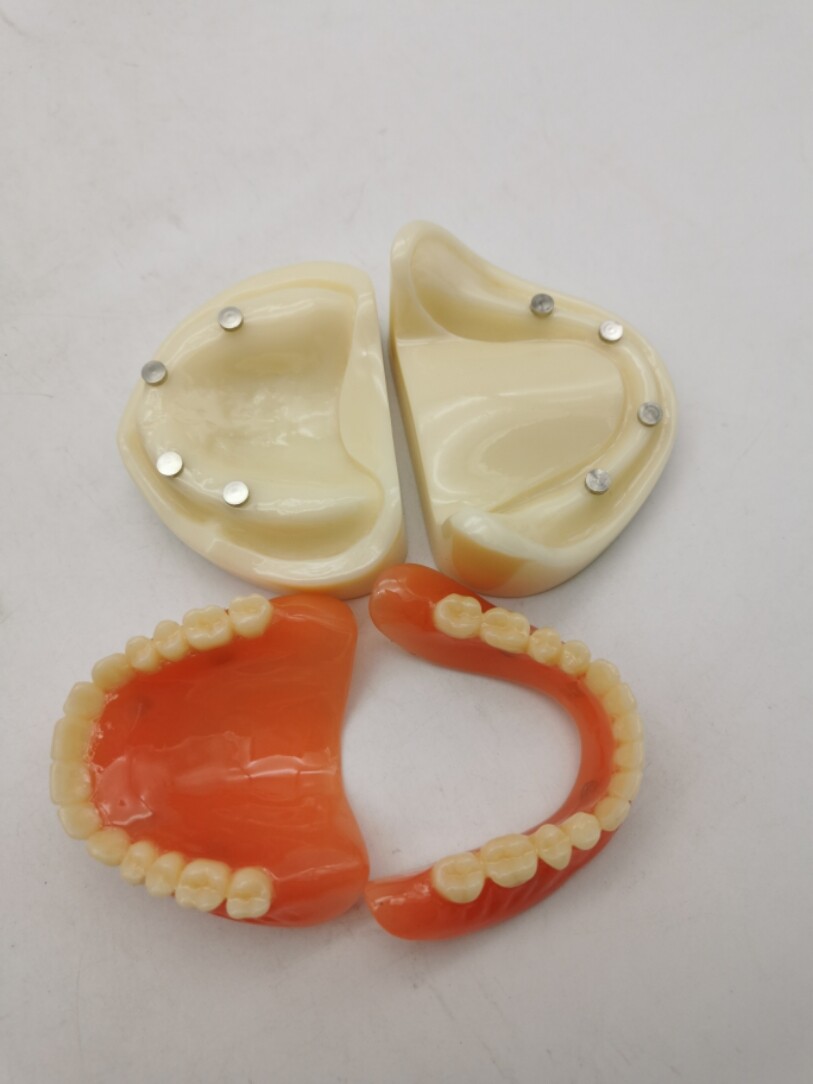 Dental 4 Implants Overdenture Typodont Restoration Upper Lower Lower Teeth Model