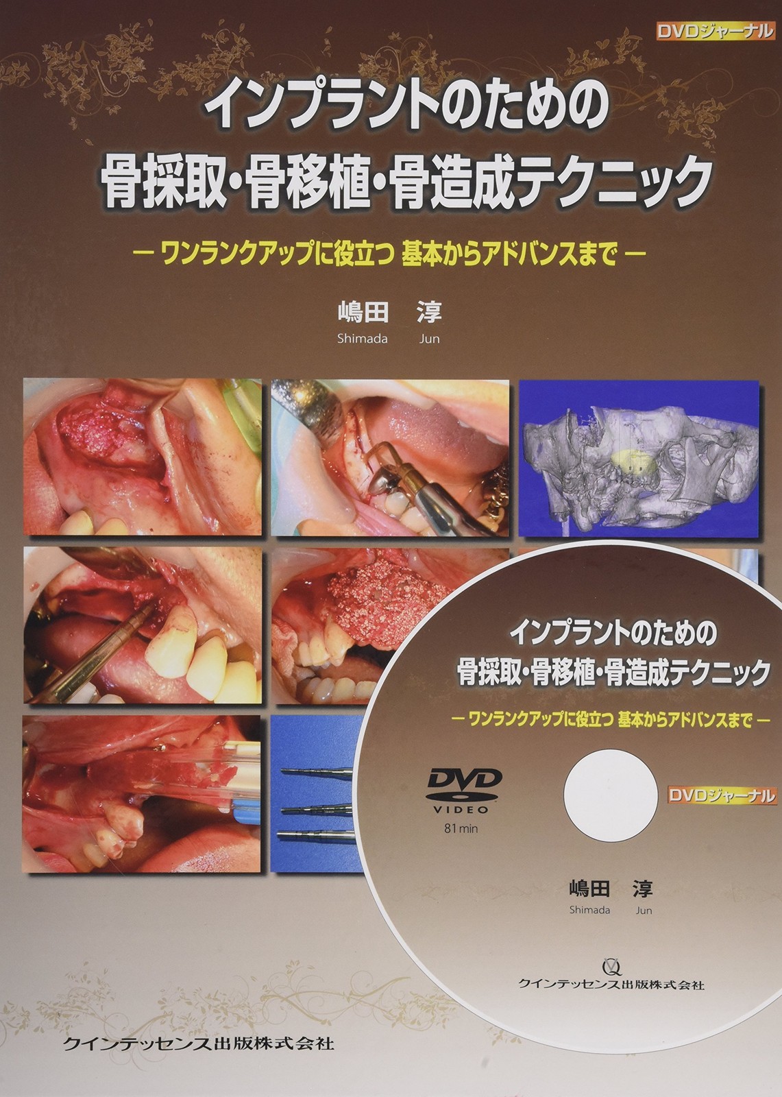 Bone harvesting, bone grafting, and bone augmentation techniques for dental impl