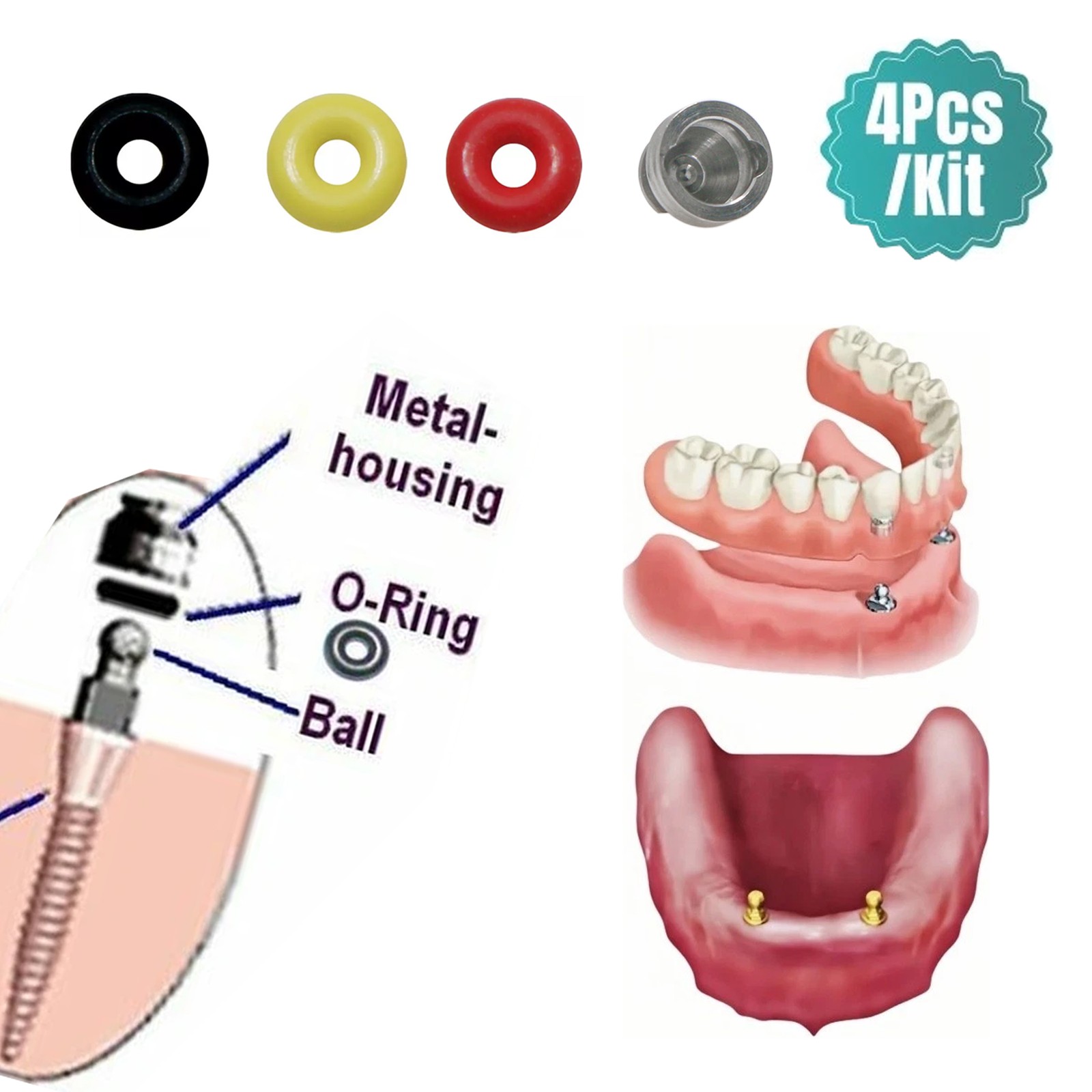 US Implant Ball Abutment O-Ring Retention Cap Set Fit Hiossen Osstem 4Pcs/Set