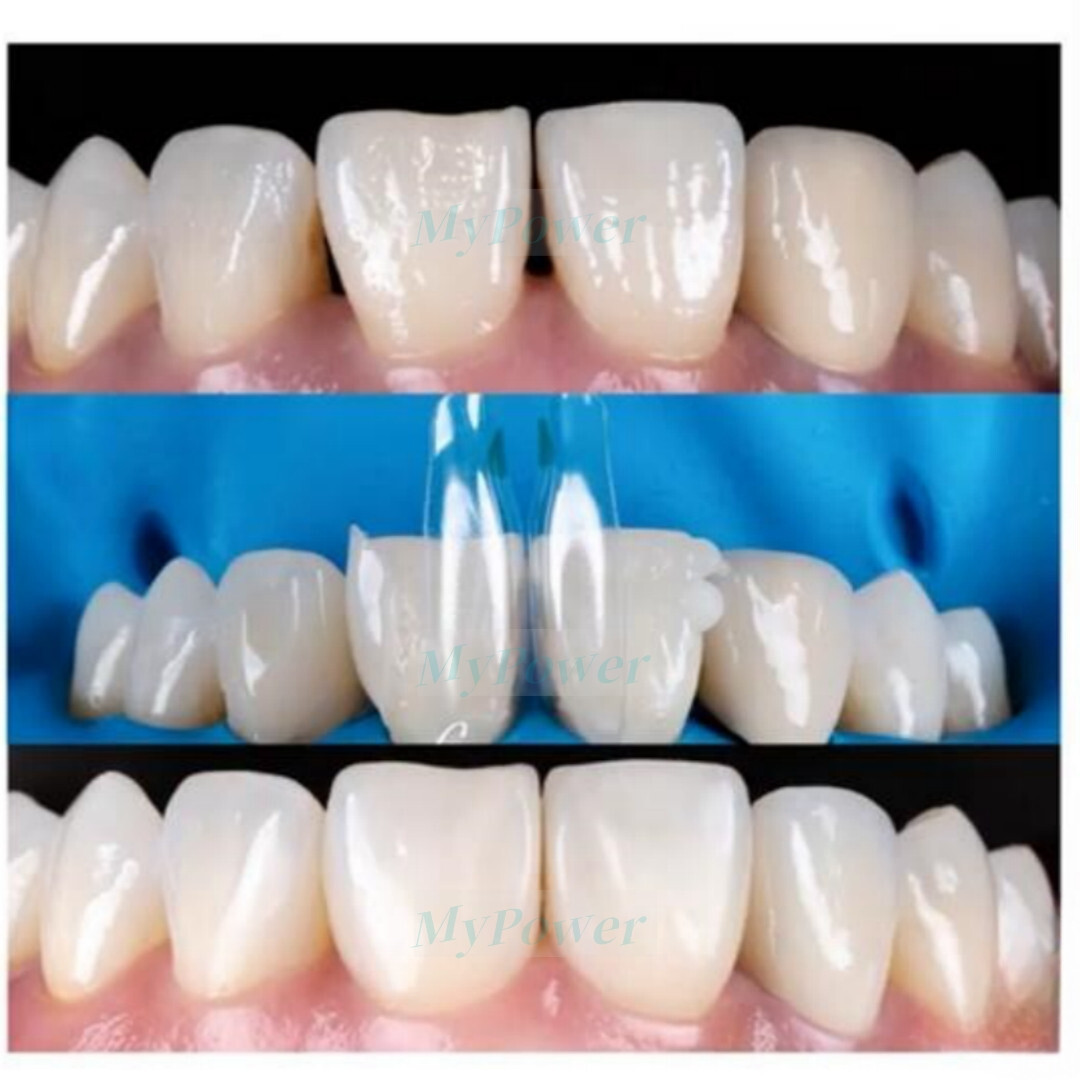 Clear Matrix Dental Diastema Matrices Wedge Similar with Bio Clear Matrice TORVM