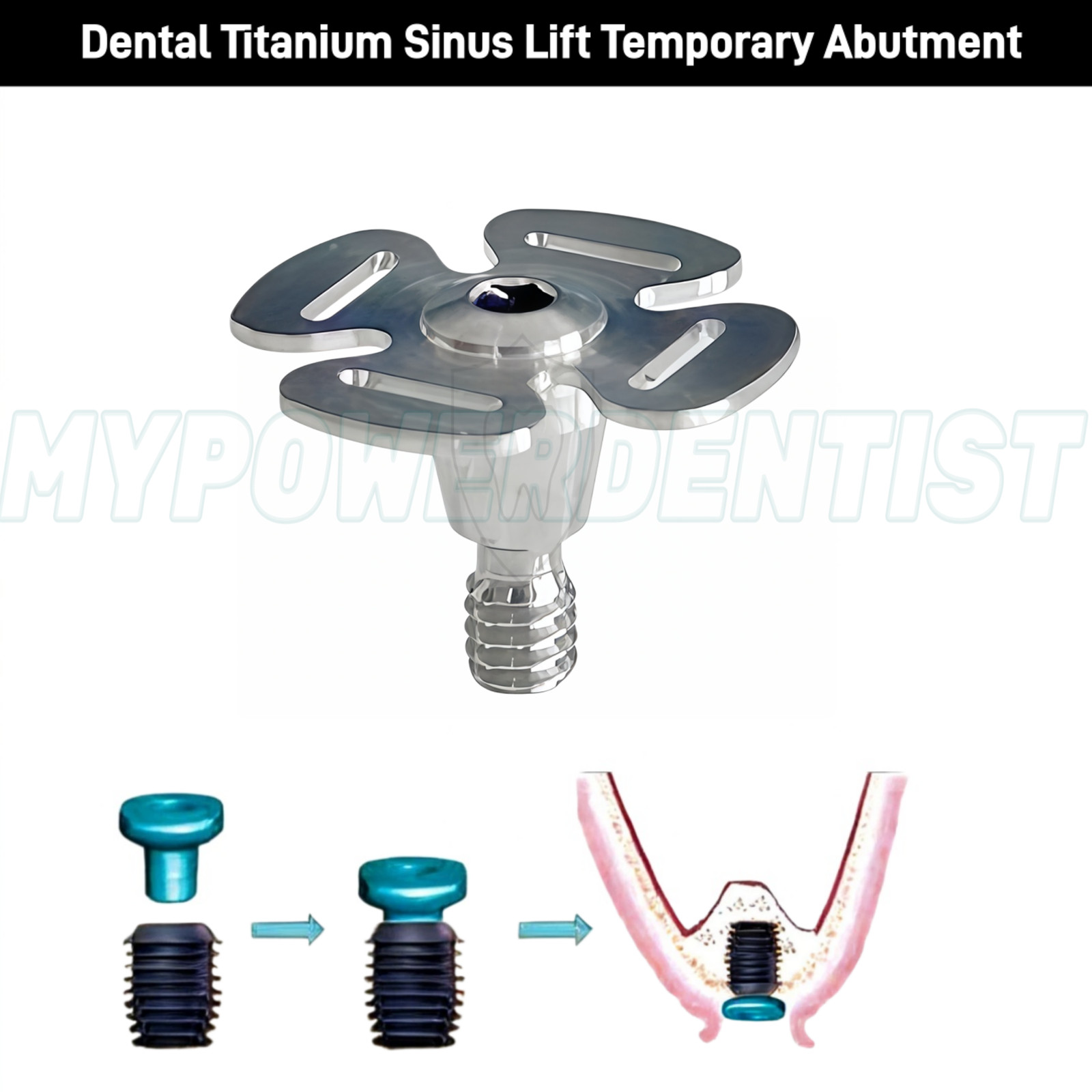 5Pcs Dental Titanium Lift Temporary Implant Abutment Repair Accessories