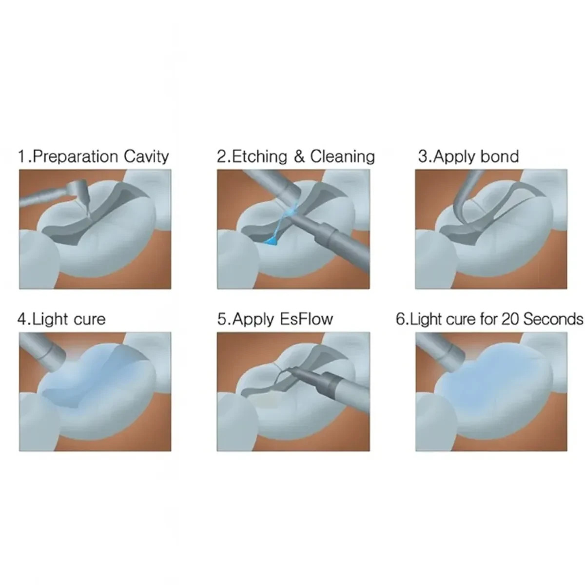 4 x CUREX BLUE Dental BITE RAISING ORTHO Light Cure Nano Hybrid Material 4gm