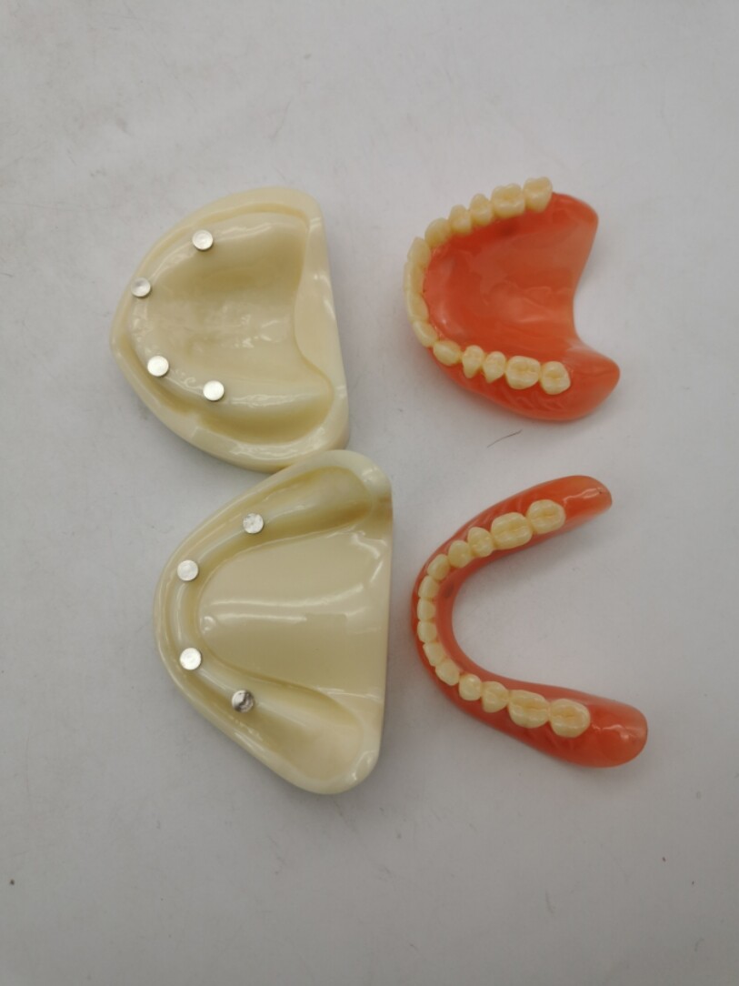 Dental 4 Implants Overdenture Typodont Restoration Upper Lower Lower Teeth Model