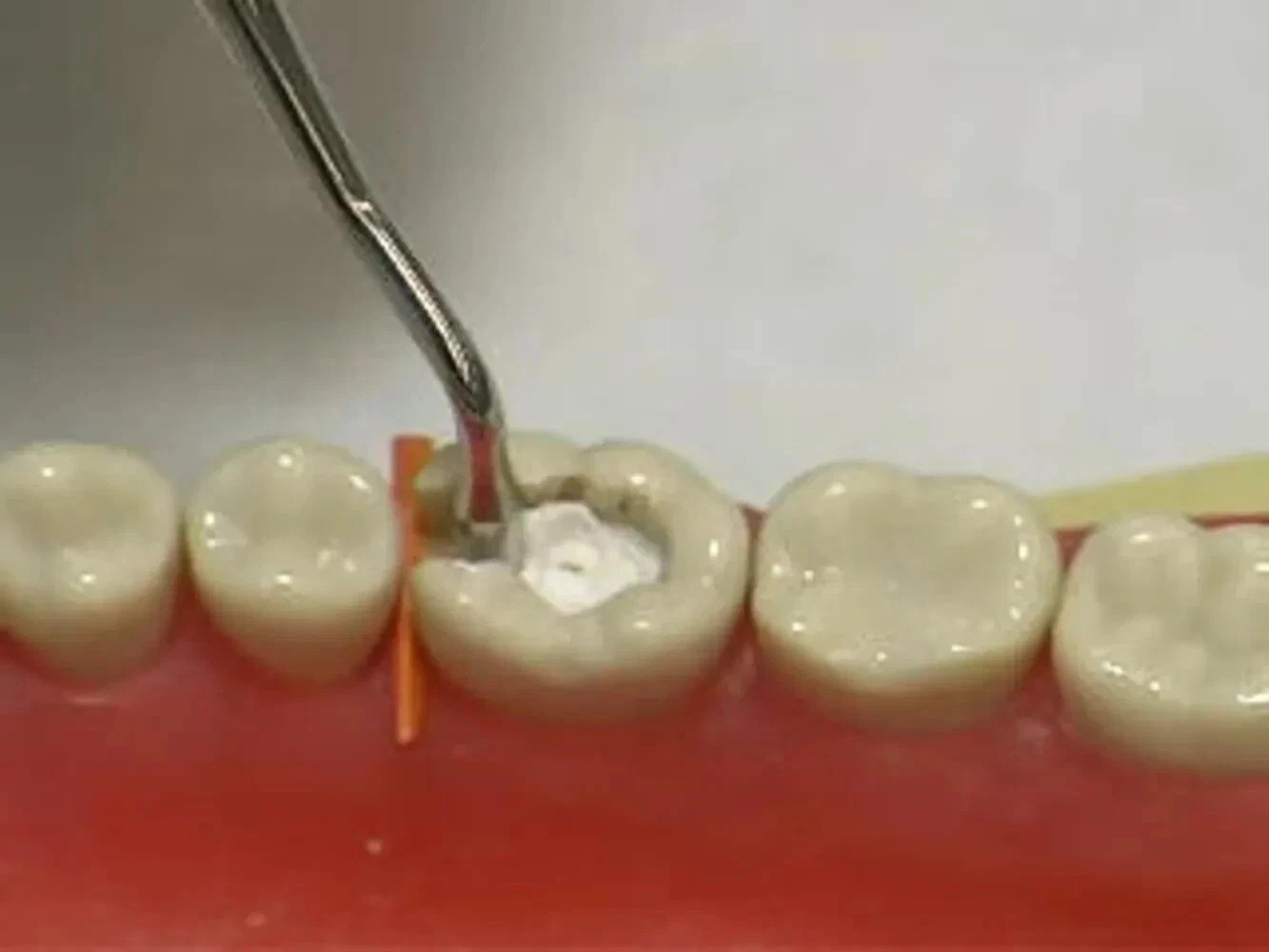 Dental ZITEMP ZOE Cement for Temporary Restoration & Cementation of Crowns